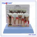 PNT-0528ad educational Osteoporosis Diseased Dental Teeth Model